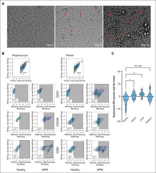 Culturing of CD34+ cells from the bone marrow of patients with MPN and RNA expression. (A) Microscopic images of the CD34+ cells isolated from the bone marrow of patients with MPN over the 15-day culture period at original magnification ×20. Notice the formation of MKs indicated with a red arrow. (B) Flow cytometric analysis of cell-surface markers to confirm the production of MK and platelet fractions after 15 days of culture of CD34+ cells from healthy cord or peripheral blood or MPN patient bone marrow sources. (C) Megakaryocytic RNA: cell culture from fresh patient bone marrow–derived CD34+ cells then differentiated over 15 days into MKs (n = 8). All RNA expression is normalized to glyceraldehyde-3-phosphate dehydrogenase and expressed as a log2 fold change. Bonferroni adjusted P values, ∗∗P < .01; ∗P < .05.