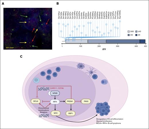 Genetic alterations and model of IRF4mut-mediated pathogenesis in LBCL-IRF4. (A) Fluorescence in situ hybridization with IRF4 break-apart probe shows a signal constellation of 1 colocalization (yellow arrow) and 1 split signal (red and green arrows) consistent with the gene rearrangement in a case with LBCL-IRF4 with pure FL morphology. (B) A diagram of the relative positions of IRF4 mutations in cases with LBCL-IRF444 (A Colmenero, I Salaverria, unpublished data, March 2023). x-axis indicates amino acid position. IRF4 domains: DBD, DNA binding domain; LKD, linker domain; IAD, IRF association domain; and AR, autoinhibitory region. (C) Schematic overview of B-cell differentiation deregulation by constitutive activation of IRF4 and/or NF-κB, which induces the oncogenic transcription program in LBCL-IRF4.