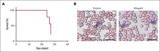 Characterization of the mouse allograft model of APL. (A) The survival of mice (n = 9) was monitored between days 0 and 27. Two mice died on day 24, 2 on day 26, and 3 on day 27. (B) Leukemic cells were identified in whole blood smears. A normal neutrophil is marked with a white arrowhead, and leukemic cells are marked with yellow arrowheads (scale bar, 50 μm).