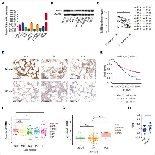 TRIM21 downregulation is associated with a high relapse rate in human MM. (A) qRT-PCR and (B) western blot analysis of TRIM21 expression in 9 MM cell lines (MM1R, MM.1S, JJN3, ARP-1, U266, U266-Bort, OPM2, RPMI8226, and CAG) and peripheral blood mononuclear cells (PBMCs) from 1 healthy donor. (C) The histochemistry score for TRIM21 was evaluated using BM biopsy samples when the patients were newly diagnosed and relapsed after treatment with a bort-based regimen (median H-score from 9.222222 to 6.388889). Pt.1 to Pt.18 represent 18 independent patients. (D) Immunohistochemical analysis of TRIM21 expression in 3 representative BM biopsies (Pt.1-Pt.3). The top panel shows TRIM21 expression in newly diagnosed patients, and the bottom panel shows TRIM21 expression after the relapse of the same patients after treatment with a bort-based regimen. Scale bars; 100 μm. (E) Kaplan-Meier survival analysis in the indicated myeloma data sets. Patients were divided into 2 groups based on TRIM21 expression levels (red curve: high TRIM21 expression; blue curve: low TRIM21 expression). (F) TRIM21 expression according to bort response (CR, n = 14; MR, n = 23; NC, n = 60; PD, n = 66; PR, n = 76). (G) TRIM21 expression in the CD138+ plasma cells of patients with monoclonal gammopathy of undetermined significance (MGUS, n = 7), MM (n = 39), and plasma cell leukemia (PCL, n = 6). The y-axis indicates the median log value of TRIM21 retrieved from the original data set. (H) MM patients with 1q amplified chromosomal abnormalities have low TRIM21 expression according to qRT-PCR detection. (∗P < .05; ∗∗P < .01; ∗∗∗P < .001).