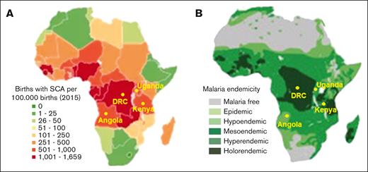 Coevolution of SCA with P falciparum malaria in Africa. (A-B) Geographical distribution of (A) SCA and (B) P falciparum malaria in Africa (adapted from Kato et al20 and Piel et al14). Locations of the Democratic Republic of Congo, Uganda, Angola, and Kenya, countries where the REACH trial is conducted, are shown.