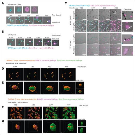 Failure of plasma membrane breakdown and extracellular DNA release by eosinophils. To induce ET formation, eosinophils and neutrophils were stimulated with (A-B, D-G) PMA (100 ng/mL), (C) MSU crystals (200 μg/mL), or opsonized C. albicans for 4 hours (unless otherwise indicated) at 37°C. (A-C) Images were acquired using a Leica SP8 confocal microscope. (A) NETosis dynamics upon PMA stimulation were assessed by live cell imaging using the permeable DNA dye DRAQ5 (cyan) and the impermeable DNA dye Sytox Green (magenta). Asterisks indicate an eosinophil. Time is displayed in hours, scale bar = 20 μm. Refer to supplemental Video 1. Results are representative of 3 independent experiments. (B) Dynamics of eosinophils upon PMA stimulation. Scale bar = 20 μm. Refer to supplemental Video 1. Results are representative of 2 independent experiments. (C) Dynamics of eosinophils and neutrophils upon exposure to MSU crystals (upper panel) or C. albicans (lower panel). Scale bar = 100 μm. Refer to supplemental Videos 2-3. Results are representative of 2 independent experiments. (D-G) Images were acquired using the ZEISS LSM 980 Airyscan 2 confocal microscope, original magnification ×400. (D-E) Dynamics of eosinophils upon PMA stimulation were assessed by live cell imaging using the plasma membrane dye CellMask Orange (orange), permeable DNA dye DRAQ5 (magenta), and the impermeable DNA dye Sytox Green (green). Time is displayed in hours, scale bar = 20 μm. Refer to supplemental Video 4. (E) Stills of supplemental Video 5, with a 360º zoom around an eosinophil illustrating that the plasma membrane of the eosinophils does not breakdown and DNA remains inside of the cell. Scale bar = 5 μm. (F-G) NETosis dynamics upon PMA stimulation. Scale bar = 20 μm. Refer to supplemental Video 6. (D) Stills of supplemental Video 7, with a 360º zoom around a neutrophil illustrating that the plasma membrane of the neutrophil breaks down, resulting in extracellular release of DNA and thus NETosis. Scale bar = 5 μm.