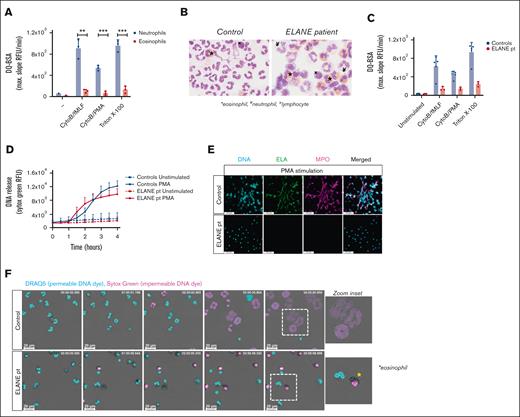 Impaired NET formation by neutrophils derived from a patient with a mutation in ELANE. (A) Protease release and proteolytic activity of neutrophils and eosinophils upon stimulation with CytoB/fMLF (5 μg/mL; 1 μM) and CytoB/PMA (5 μg/mL; 100 ng/mL) were determined by DQ-green BSA. A Triton X-100 lysate was used as 100% (mean + standard deviation, n = 3). (B) Representative cytospins of isolated granulocyte fractions from controls and patient (original magnification ×400; May-Grünwald/Giemsa stain). These cell suspensions were used in panel F. ∗eosinophil, ¥neutrophil, xlymphocyte. (C) Protease release and proteolytic activity by control (n = 5) and ELANE patient (n = 3) granulocytes (mean + standard deviation). (D-F) To induce ET formation, cells were stimulated with PMA (100 ng/mL) for 4 hours, and (D) DNA release was measured in real-time by Sytox Green Nucleic Acid Stain (mean + standard deviation, n = 4 for controls, n = 3 for ELANE patient) and (E) ETs were visualized by staining for neutrophil elastase (NE, green, 488), DNA (Hoechst, blue, 405), and myeloperoxidase (MPO, magenta, 633). Images were acquired using a Leica SP8 confocal microscope, original magnification ×400. Scale bar = 50 μm. Results are representative of 3 independent experiments. (F) NETosis dynamics upon PMA stimulation were assessed by live cell imaging using the permeable DNA dye DRAQ5 (cyan) and the impermeable DNA dye Sytox Green (magenta). Asterisk indicates an eosinophil. Time is displayed in hours, scale bar = 20 μm. Refer to supplemental Video 8. Results are representative of 2 independent experiments. (A) Statistics were performed by unpaired t test; ∗∗P < .01; ∗∗∗P < .001.
