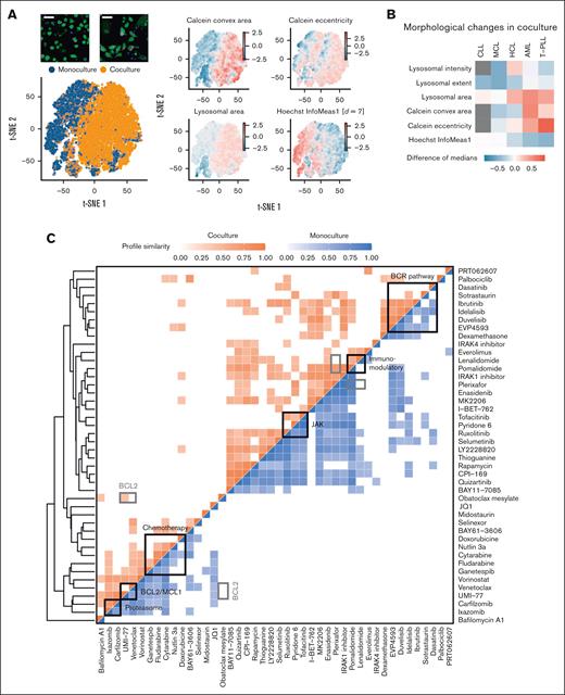 Compound similarity in monoculture and coculture. (A) Joint t-SNE embedding of viable leukemia cells in monoculture and coculture controls of an AML sample. Coloring by morphological features revealed that AML cells in coculture had more elongated shapes (higher eccentricity), larger cell (Calcein), and lysosomal area as well as lower local correlation between pixel intensity values in x- and y-direction (Hoechst InfoMeas1). (B) Heatmap showing morphological changes in coculture controls across all screened disease entities. Gray indicates missing values. (C) Aggregated compound profiles were used to generate a hierarchical clustering of all probed compounds, excluding combinations. Pearson correlation was applied to compare drugs among each other separately in monoculture and coculture. Only high correlations (r > 0.4) are indicated in the heatmap. All shown correlations have P values < .001. Refer to “Materials and methods” for details.
