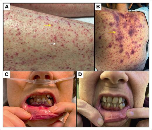 Cutaneous manifestations of scurvy. (A) Perifollicular hemorrhage (yellow arrow) and petechiae in patient 1; Corkscrew hair in patient 1 (white arrow). (B) Petechiae and ecchymoses (yellow arrow) in patient 2. (C) Mucosal ulceration and gingival bleeding in patient 4. (D) Resolution of mucosal ulceration and gingival bleeding in patient 4 after Vc supplementation.