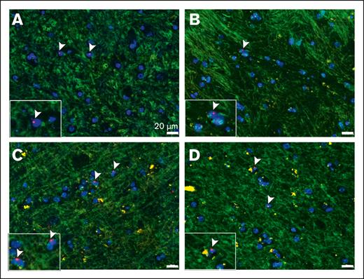 Detection of male donor cells via XY FISH. Representative XY FISH of frontal cortex biopsy specimen from 4 separate female patients with a history of sex-mismatched stem cell transplantation (A-D) Arrow-head, male donor cells. Light green, autofluorescence background highlighting the tissue architecture. Red probe, Y chromosome; green probe, X chromosome; blue, DAPI nuclei. Original magnification ×400; scale bar, 20μm.