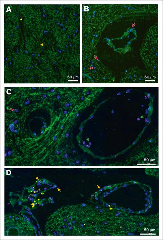 Distribution of male donor cells in the cerebral cortex, detected via XY FISH. Representative cortical biopsy sections from female patients with a history of sex-mismatched stem cell transplantation, illustrating the distribution of male donor cells. (A) Most donor cells exist as individual cells within the cortical gray matter (orange arrows). (B-C) Male donor cells are enriched in perivascular location (red arrows). Background autofluorescence identifies small blood vessels and intravascular donor cells (green arrows). (D) Donor cells are enriched along the cortical surface adjacent to the arachnoid membrane (orange arrows). Red probe, Y chromosome; green probe, X chromosome; blue, DAPI-stained nuclei. Original magnification ×400; scale bar, 50μm.