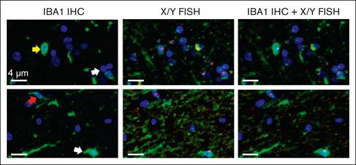 Tyramide IHC and XY FISH show that male donor cells express IBA1. Representative images from tyramide IBA1 IHC and XY FISH of 2 separate samples (top and bottom rows). (Column 1) tyramide-based IBA1 IHC (green); (column 2) same sections after XY FISH; (column 3) digital overlap of IHC and FISH images. Arrows indicate donor cells. Donor cells are present in both amoeboid (yellow arrow; top) and ramified (red arrow, bottom) forms, with a lower expression of IBA1 in ramified cells. Green, IBA1 IHC; red probe, Y chromosome; green probe, X chromosome; blue, DAPI-stained nuclei. Images taken at original magnification ×400; scale bar, 4 μm.