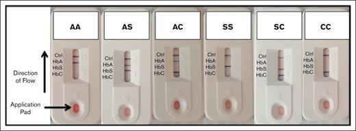 Sickle SCAN POC test. The Sickle SCAN results are noted by the presence of a band aligned with each hemoglobin type, including HbA, HbC, and HbS, with a control band to ensure the test is working properly. The Sickle SCAN test can qualitatively identify the presence or absence of HbA, HbS, and HbC and can accurately distinguish the most common forms of SCD (HbSS and HbSC) from the carrier states (HbAC and HbAS).