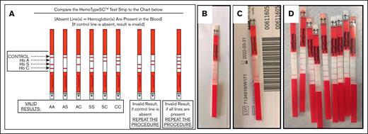 HemoTypeSC POC test. HemoTypeSC is a competitive immunoassay, such that the presence of a band indicates the absence of that particular hemoglobin. (A) Panel A demonstrates the interpretation of results. The HemoTypeSC test can qualitatively identify the presence or absence of HbA, HbS, and HbC. The subsequent panels are real-world examples from the study of results demonstrating the diagnosis of HbSS (B) and sickle cell trait (C). (D) Panel D shows the indeterminate result that indicates the presence of all 4 bands, which occurred in 4.2% of tests in this study.