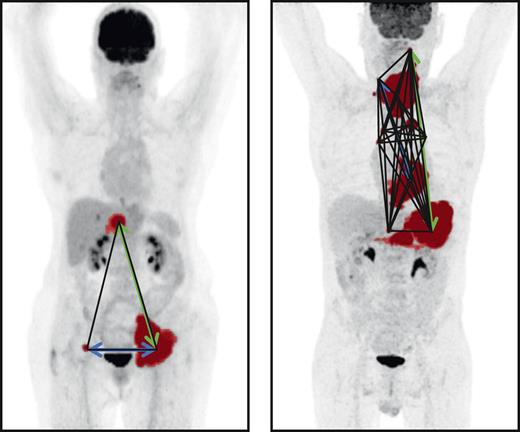Maximum intensity projections of 2 patients. MTV is indicated in red, Dmaxbulk with a green arrow, DSUVpeakpatient with a blue arrow, and Spreadpatient with black lines.