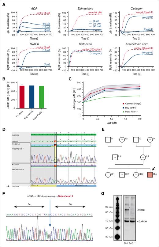 Platelet characterization and molecular genetic analysis of Pat01∗ using a novel RASGRP2 variant. (A) Aggregation of platelet-rich plasma (light transmission %) from Pat01∗ (blue curves) and healthy control (dotted red curve), induced by ADP (4-20 μM), epinephrine (8-40 μM), collagen H (2-10 μg/mL), TRAP6 (5-10 μM), or arachidonic acid (0.5 mg/mL). Platelet agglutination was induced using ristocetin (1.2 mg/mL). (B) Flow cytometric analysis of diluted platelet-rich plasma, showing normal expression of αIIbβ3 (CD41). (C) Flow cytometry indicating impaired ADP-induced fibrinogen binding to Pat1∗ platelets, compared with those of CCFs (20 measurements from 6 controls; mean ± standard deviation). (D) Verification of a homozygous RASGRP2 canonical splice site variant by direct sequencing. (E) Pedigree after segregation analysis (brown symbol indicates affected Pat III.4; dotted symbol indicates heterozygous carrier). (F) Direct sequencing of platelet-derived cDNA showing skip of exon 5. (G) Absence of CalDAG-GEFI protein (CDGI) in patient platelets compared with that in a control subject via western blotting. GAPDH, glyceraldehyde-3-phosphate dehydrogenase.