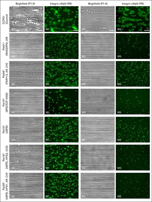 Altered thrombus formation in the blood of index patients with confirmed genetics. Whole blood from patients and control subjects was perfused over microspots from M1 to M6 for 3.5 minutes at a wall-shear rate of 1000/s. Brightfield and fluorescence images were captured using an EVOS-FL microscope and a 60× oil objective and analyzed for platelet phenotypes. Shown are representative brightfield and fluorescence (FITC α-fibrinogen mAb for integrin αIIbβ3 activation) images at the end stage (scale bar, 20 μm) for microspots M1 (collagen 1) and M3 (collagen 3). Results for a control subject (CCF01), index patients with a defect in RASGRP2 (Pat01∗) or P2RY12 (Pat06∗), SPD with TCP (SPD, VWD, and TCP) (Pat10∗), δ-SPD (no variant identified, Pat13∗), or compound heterozygous variants of HPS3 (Pat19∗) or HSP1 (Pat29∗) genes. FITC, fluorescein isothiocyanate.