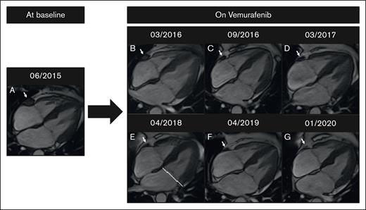 Change in CMR image results in a patient on vemurafenib. (A) Baseline. (B-G) Complete regression of right atrioventricular sulcus infiltration on vemurafenib over 4 years. CMR imaging was performed on a 1.5T MR scanner (Siemens Aera).