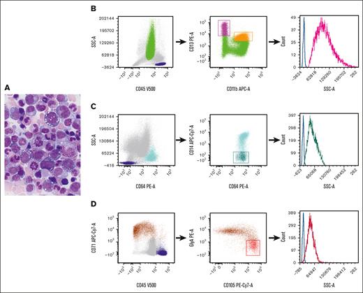 Representative morphology in aspirate smear and flow cytometric gating strategy. (A) Wright-Giemsa–stained BM aspirate smear from a patient with VEXAS syndrome, demonstrating cytoplasmic vacuoles in myeloid and erythroid precursors. (B-D). Flow cytometric gating strategy for (B) neutrophil, (C) monocyte, and (D) erythroid precursors. (B) Dot plots of neutrophils selected based on their CD45 expression and SSC properties (green). The CD11b and CD13 expression on neutrophils allows for the delineation of neutrophil maturation stages, ranging from the least mature (high CD13/low CD11b) (magenta) to the most mature ones (high CD13/high CD11b) (orange).8 (C) The identification of monocytes (light blue) based on their intense CD64 expression and SSC properties, and the selection of immature monocytes based on their poor expression of CD14 (dark green). (D) The selection of nucleated red blood cells (brown) based on their intense CD71 expression and poor or no expression of CD45. Early red cell precursors are identified by their high CD105 and relatively low glycophorin A expression (red). The histograms on the right graphs depict the SSC intensity of precursors (neutrophil precursors, magenta; monocyte precursors, dark green; and early red cell precursors, red). Lymphocytes are selected based on CD45 and SSC properties (dark blue) and the SSC intensity of CD4+ cells (identified based on their coexpression of CD3 and CD4; not shown) serves as internal controls (blue lines). APC-Cy, allophycocyanin; GlyA, glycophorin A; PE, phycoerythrin.