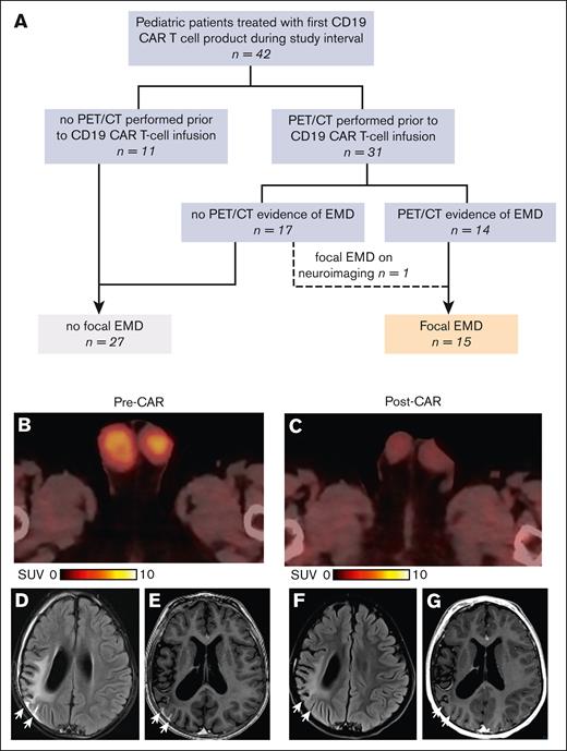 Identification of the cohort with EMD and representative imaging-based responses. (A) Identification of focal EMD among pediatric patients with r/r B-ALL treated with CD19 CAR T-cell therapy. (B-C) 18F-FDG PET/CT fusion images from UPN4 with testicular disease, with bilateral FDG-avid testicular enlargement before CAR T-cell infusion (B), which completely resolved after infusion (C). (D-G) Magnetic resonance imaging findings in UPN15 with focal CNS disease. Postcontrast axial T2 fluid-attenuated inversion recovery image (D) and 3D T1 image (E) through the level of the lateral ventricles obtained before CAR T-cell therapy demonstrated leptomeningeal enhancement along 2 of the right parietal sulci, suggesting leukemic infiltrate (D-E) (white arrows), which completely resolved after therapy on after contrast T2 fluid-attenuated inversion recovery image (F) and 3D T1 image (G) (arrows).