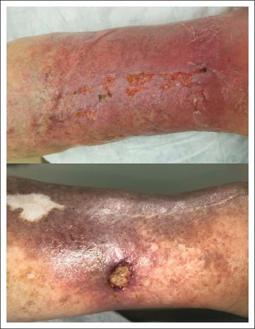 Clinical features of LV in a patient (P8) with a positive mHam test result. (Top) Active ulcers on a background of purple, discolored skin. (Bottom) Healing ulcer with evidence of atrophie blanche and postinflammatory hyperpigmentation.