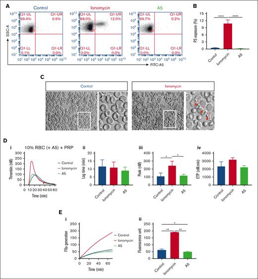 Altered TG by increasing or blocking phosphatidylserine exposure on RBC. (A-B) Flow cytometry of phosphatidylserine exposure of washed RBC after 30 minutes treatment with 10 μM ionomycin/CaCl2 or with 7.5 μg/mL annexin A5/CaCl2 (A5), analyzed after labeling with FITC–annexin A5. Shown are representative fluorescence-scatter profiles (F1 vs SSC) (A) and fractions of phosphatidylserine-exposing RBC (B). Visualization of RBC without or with ionomycin/CaCl2 treatment (C). Arrows indicate activated, rounded RBC. (D) Effect of RBC treatment with ionomycin/CaCl2 or annexin A5/CaCl2 and wash, in comparison with no treatment (control) on TG in PRP samples reconstituted at 10% hematocrit at 0.1 pM tissue factor. Panels show representative curves (i), quantified lag times (ii), thrombin peak levels (iii), and ETP values (iv). (E) Effect of RBC treatment with ionomycin/CaCl2 or annexin A5/CaCl2 on factor Xa generation in a purified system. Indicated are representative factor Xa generation curves (i) and increased fluorescence units over 40 minutes (ii). Means ± SD (n = 3), 1-way ANOVA, ∗P < .05; ∗∗P < .01; ∗∗∗P < .001.