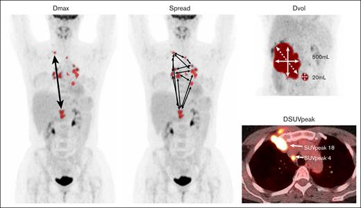 Examples of radiomics features. All definitions of radiomics features are listed in supplemental Table 3. Dmax, maximum distance between 2 lesions; DSUVpeak, maximum difference in SUVpeak between 2 lesions; Dvol, maximum difference in volume between 2 lesions; spread, sum of the distances between all lesions.
