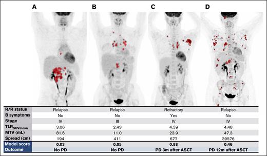 Examples of maximum intensity projections of baseline PETs in 4 different patients with R/R cHL. The model score was calculated based on the prognostic model using clinical and radiomics features. The outcome represents the clinical outcome of the patient. (A-B) Patients with a low prediction score with low risk of progressive disease. (C-D) Patients with a high prediction score with a high risk of progressive disease. m, months; PD, progressive disease.