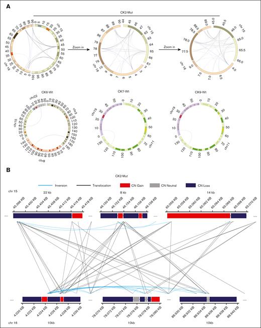 Chromocataclysm in CK-AML. (A) Circos plot of a chromocataclysm rearrangement in CK2-Mut and noncomplex rearrangements in CK6-Wt, CK7-Wt, and CK9-Wt. A clustering of breakends is preserved at all 3 stages of magnification shown here for case CK2-Mut. The clustering is here shown at full chromosome view on the left to increasing levels of magnifications in the middle and to the right indicating a chromocataclysm like pattern. Numbers indicate position on the chromosome in megabases. CK7-Wt and CK9-Wt have a similar BND connecting chromosomes 19 and 11. (B) Detailed view of some of the most complex regions that are involved in the chromocataclysm rearrangement of Chr15 and Chr16 in CK2-Mut, illustrating the extreme local complexity of CNVs and breakends. Bars show the local CN of the involved fragments. Blue: CN loss (CN < 1.7). Gray: CN stable (CN 1.7 ≤ x ≤ 2.3). Red: CN gain (CN > 2.3). Black lines show translocations (breakends on 2 different chromosomes), blue lines show inversions (breakends on the same chromosome). Dots connecting the displayed regions represent regions that are due to the complexity of the rearrangement not shown here. If breakends from the displayed regions projected to the nondisplayed regions, connections were still shown here by blue or black lines.