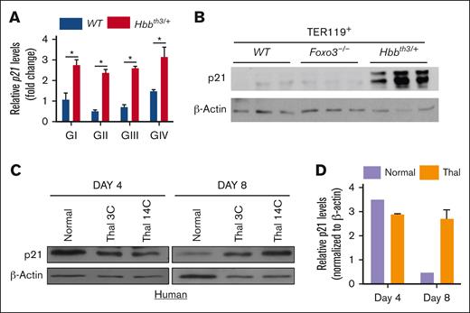 P21 is upregulated in β-thalassemia erythroid cells. (A) qRT-PCR expression analysis of P21 in TER119+ (GI-GIV) cells. (B) Immunoblotting of P21 protein expression in WT, Foxo3−/−, and Hbbth3/+ TER119+ erythroblasts. Results are shown as mean ± SD; ∗P < .05 (n = 3 mice). (C) Immunoblot analysis of P21 expression in erythroblasts derived from healthy donors and CD34+ cells from patients with β-thalassemic. (D) Quantification of data shown in panel C.