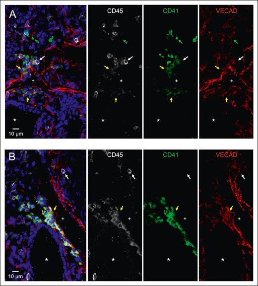 Immunofluorescent staining shows that in situ fetal lung EHT is directed toward the interstitium. Twelve μm sections of a fixed frozen postconception week-20 human fetal lung stained with the broad hematopoietic marker CD45, the EHT marker CD41, the endothelial marker VECAD, and the nuclear stain Hoechst. The lumen of a large vessel lined with VECAD+ staining is highlighted with a “+,” and the lumen of a VECAD– developing epithelial space is highlighted with a “∗.” (A-B) Cells coexpressing VECAD, CD41, and CD45 are highlighted with yellow arrows showing developing hematopoietic clusters oriented toward the lung interstitium. Anucleate platelets single-positive for CD41 are highlighted with green arrows. Differentiated hematopoietic cells only positive for CD45 are highlighted with white arrows. A wide-field image of section (A), a section including ECAD staining, and a control stain is included in supplemental Figures 8, 10, and 11.