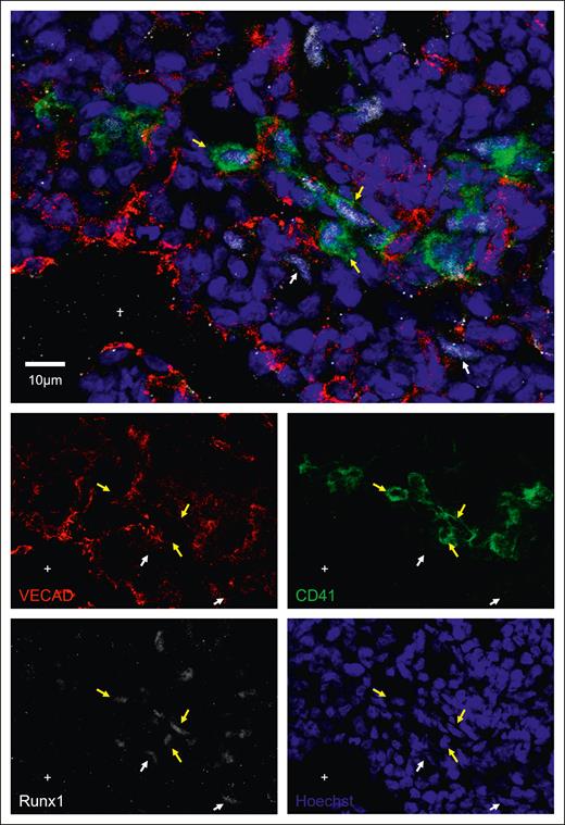Immunofluorescent staining shows Runx1 expression during in situ fetal-lung EHT. Twelve μm sections of a fixed frozen postconception week-20 human fetal lung stained with the EHT marker CD41, the nuclear EHT marker Runx1, the endothelial marker VECAD, and the nuclear stain Hoechst. Cells that are Runx1+ and VECAD+ are highlighted with a white arrow, whereas cells that are Runx1+ and CD41+ are highlighted with a yellow arrow. The lumen of a large vessel lined with VECAD+ staining is highlighted with a “+.” Additional Runx1 staining can be found in supplemental Figure 9.