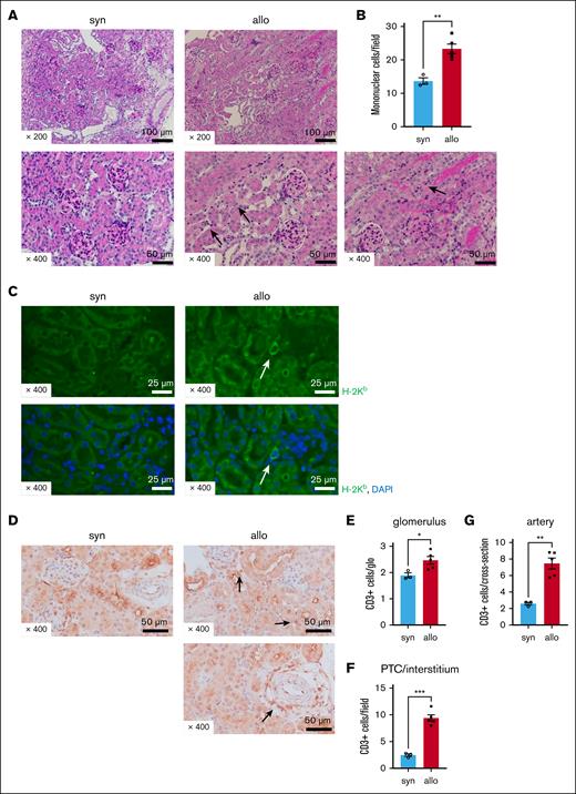 Renal damage and donor T-cell infiltration are increased in allo-HCT recipients. BALB/c (H-2d) animals were lethally irradiated and received transplantation with CD90.2+ splenic T cells together with BM cells from either syn BALB/c or allo MHC-mismatched B6 (H-2b) donors. The kidneys were collected from recipient mice on day 14 after HCT. (A) Representative images of PAS-stained kidneys after HCT are shown. Compared with the syn group, there was increased mononuclear cell infiltration in the peritubular capillaries (PTCs; see arrows in center bottom row image) and tubules (see arrows in right bottom row image) of allogeneic recipients. (B) Quantification of infiltrating mononuclear cells (MNCs) in kidneys is shown. The number of infiltrating MNCs per 200× original magnification field is significantly higher in allo mice than in syn mice. (C) Representative H-2Kb (green) and 4′,6-diamidino-2-phenylindole (DAPI; blue) immunofluorescence images are shown. H-2Kb–positive donor-derived cells were found in the kidneys of allogeneic recipients. (D) Representative images of immunohistological staining for CD3 are shown. Allogeneic recipients demonstrated increased CD3+ T-cell infiltration in the peritubular, perivascular, and glomerular areas relative to syngeneic recipients. (E-G) Quantification of T cells infiltrating the kidneys is shown. The absolute number of CD3+ T cells infiltrating the glomeruli (E), interstitium (F), and perivascular area (G) was significantly higher in allogeneic mice than in syngeneic mice; n = 3 to 5 mice per group. Data shown represent 2 experiments. Magnifications are shown in the figures. The bars represent the mean ± SEM. Student t test was used for statistical analysis; ∗P < .05; ∗∗P < .01; ∗∗∗P < .001 for panels B,E-G.