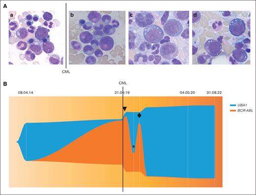 Bone marrow aspirate and molecular analysis. (A) Bone marrow aspiration cytology (hematoxylin and eosin staining; original magnification ×1000). a) April 2014, showing vacuoles in myelomonocytic precursor cells and erythroblast. (b) June 2019, showing no vacuolation in myelomoncytic precursor cells at CML diagnosis. (c) January 2020 and (d) March 2022: showing vacuoles in myelomonocytic precursor cells and erythroblasts. (B) Visualization of clonal dynamics (performed using R v. 4.3.1 and package fishplot version 0.23) between UBA1 variant p.Met41Val allele burden (variant allele frequency %) and BCR-ABL:ABL1 ratios (International Scale (IS) %). Line, CML diagnosis in June 2019; ▼ imatinib initiation in July 2019; ∗ imatinib withdrawal in November 2019; ♦ nilotinib initiation in February 2020.
