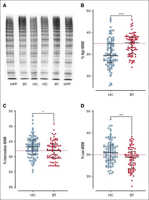 VWF multimer distribution in children with SCD treated with hydroxycarbamide compared to blood transfusion. (A) Representative images of VWF multimer distribution in HC and BT cohorts. Percentage of (B) high-, (C) intermediate-, and (D) low-molecular-weight VWF multimers. Comparisons between groups were assessed by the Mann-Whitney U test. Dotted red lines represent the percentage of high-, intermediate-, and low-molecular-weight multimers in normal pooled plasma (NPP); ∗P < .05, ∗∗∗P < .001, and ∗∗∗∗P < .0001.