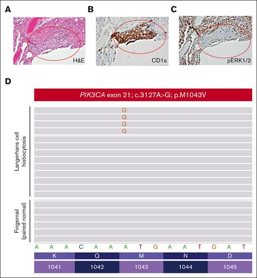 Pathological evaluation of a patient with PIK3CAM1043V-mutated Langerhans cell histiocytosis. (A) Lung wedge biopsy showing infiltration of lung parenchyma by Langerhans cell histiocytosis (red oval) (H&E; 100× magnification). (B) CD1a immunohistochemistry confirming infiltration of lung parenchyma by Langerhans cell histiocytosis (red oval) (CD1a immunohistochemistry; 100× magnification). (C) Phospho-ERK1/2 (pERK1/2) immunohistochemistry demonstrating a lack of expression of pERK1/2 by the Langerhans cell histiocytosis of the patient (pERK1/2 immunohistochemistry; 100× magnification). (D) PIK3CA c.3127A>G; p.M1043V missense mutation detected by targeted next-generation sequencing of the Langerhans cell histiocytosis involving the lung biopsy of the patient that was absent in paired normal fingernail DNA.