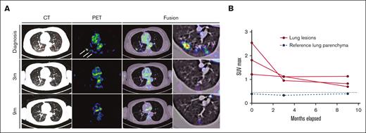 Response dynamics of pulmonary LCH involvement sites upon PI3Kα inhibition. (A) PET, CT, and fusion axial data layers at the level of the lungs were derived from PET/CT studies performed before and during systemic treatment with alpelisib. (B) Quantification of lesion SUVmax values as apparent in panel A. Abnormal FDG uptake in multiple lung nodules on the diagnostic PET image (white arrows). CT, computed tomography; FDG, fluorodeoxyglucose; PET, positron emitted tomography; SUVmax, maximum standard unit value.