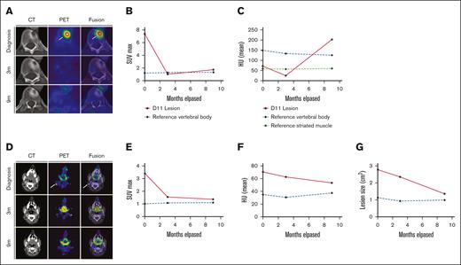 Response dynamics of skeletal and nodal LCH involvement sites upon PI3Kα inhibition. (A-C) panels depicting imaging data relevant to the lytic lesion in T11. (A) PET, CT, and fusion axial data layers at the level of vertebra T11 derived from PET/CT studies performed before and during systemic treatment with alpelisib. (B-C) Quantification of lesion (B) SUVmax values and (C) HU as apparent in panel A increase in 9 m; HU: P < .001. (D-G) Panels depicting imaging data relevant to the right-sided cervical lymphadenopathy. (D) PET, CT, and fusion axial data layers at the level of vertebra C1 derived from PET/CT studies performed before and during systemic treatment with alpelisib. (E-G) Quantification of lesion (E) SUVmax values, (F) HU and dimensions (G) as apparent in panel D. Abnormal FDG uptake foci in the diagnostic PET and fusion images in A and D are indicated by white arrows. CT, computed tomography; FDG, fluorodeoxyglucose; HU, Hounsfield units; PET, positron emitted tomography; SUVmax, maximum standard unit value.