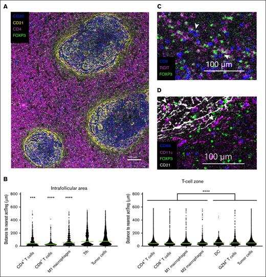 Spatial single-cell analysis of FL tissues. Imaging mass cytometry was performed on tissue section from formalin-fixed paraffin-embedded FL samples (n = 4). (A) Shown is 1 representative image with FOXP3 (green, Tregs), CD4 (pink), CD20 (blue; tumor cells), and CD21 (yellow; follicular dendritic cells) delimiting the follicles and T-cell zone. Scale bar, 100 μm. (B) Scatter plots depicting the median distance of different cell populations to the nearest actTreg, localized either in the T-cell–rich zone or in the intrafollicular area. Statistical differences were calculated using Kruskal-Wallis test and Dunn multiple comparisons (supplemental Table 8). ∗∗∗P < .001 and ∗∗∗∗P < .0001. (C) actTregs can colocalize with CD8 T cells. Shown is a selected area from the T-cell zone of panel A, with FOXP3 (green), TIGIT (pink), and CD8 (blue). Arrow heads point at FOXP3+TIGIT+ actTregs in proximity to CD8+ T cells. (D) actTregs can colocalize with dendritic cells (DCs) and macrophages. Shown is 1 representative area from the image in panel A, with FOXP3 (green), CD11c (pink, DCs), CD68 (blue, macrophages), and CD21 (white). Arrow heads point at Tregs in proximity to DCs, whereas arrows point at Tregs in proximity to macrophages.