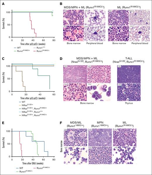 Runx1R188Q/+ predisposes to a variety of hematologic malignancies in cooperation with other somatic mutations. (A) Kaplan-Meier survival curve of WT, Runx1R188Q/+, Runx1Δ/+, and Runx1R188Q/Δ mice. (B) Histology analysis of BM and peripheral blood of Runx1R188Q/Δ mice with HM. (C) Kaplan-Meier survival curve of mice with Runx1 mutations and NrasG12D/+ allele. (D) Histology analysis of BM, and thymus of Runx1R188Q/ΔNrasG12D/+ mice with HM. (E) Kaplan-Meier survival curve of mice treated with ethyl-nitrosourea (ENU). (F) Histology analysis of BM of ENU-treated Runx1R188Q/Δ mice.