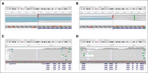 Genomic alterations in DDX41. (A) RNA-sequencing demonstrated retention of intron 6 with a predicted stop codon after 11 residues in a patient with variant c.571G>A, p.(Ala191Thr). (B) RNA-sequencing showed intron retention in the patient with the synonymous variant c.1230G>A, p.(Gln410Gln). Structural variant calling (GRIDSS) identified 2 patients with novel multiexon deletions: NC_000005.9:g.176937300_176939456del (C) and NC_000005.9:g.176941255_176942766del (D).