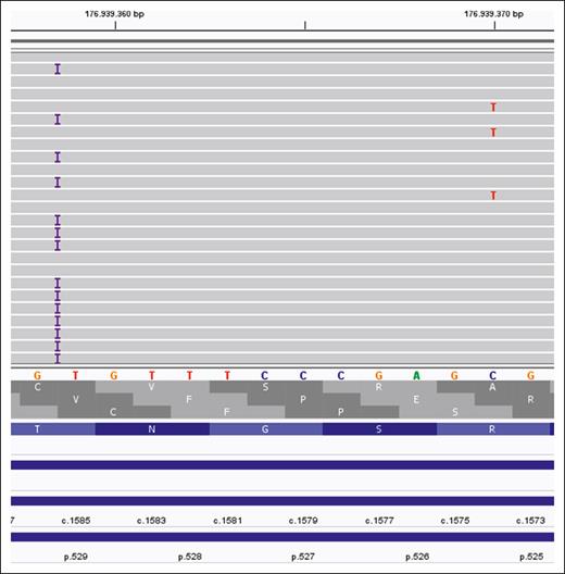 Phase analysis of sequencing from patient MDS-P124 demonstrating the germ line variant c.1585dup/p.(Thr529Asnfs∗13) and the somatic variant c.1574G>A/p.(Arg525His) demonstrating their presence in different reads/alleles. The germ line variant c.1585dup/p.(Thr529Asnfs∗13) is indicated by the purple bar, and the somatic variant c.1574G>A/p.(Arg525His) is indicated by a red T.