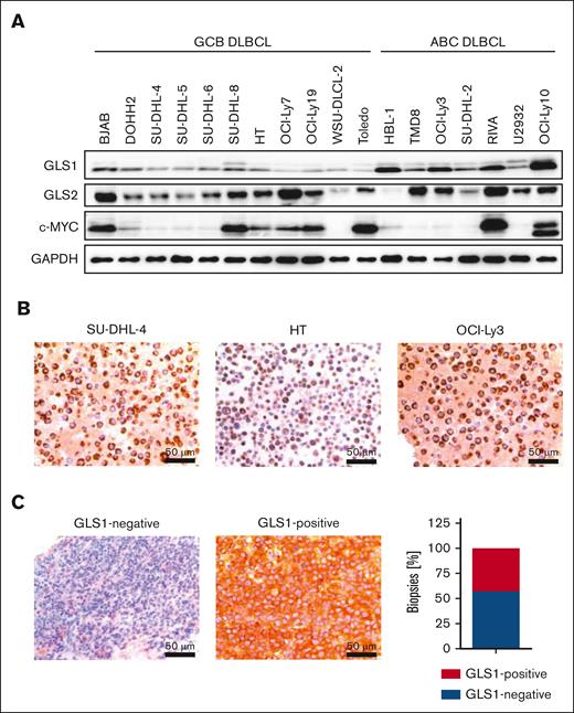 GLS1 expression in human DLBCL cell lines and biopsy samples. (A) GLS1, GLS2, and c-MYC protein expression in various ABC and GCB DLBCL cell lines was analyzed by immunoblotting. GAPDH served as loading control. Note that the protein doublet of the GLS1 blot might correspond to different GLS1 isoforms. (B) Immunohistochemical staining of GLS1 in human ABC and GCB DLBCL cell lines. Scale bars, 50 μm. (C) Immunohistochemical staining of GLS1 in human DLBCL biopsies (left pictures). The cytoplasmic GLS1 expression was quantified in DLBCL biopsy samples (n = 42, right panel).