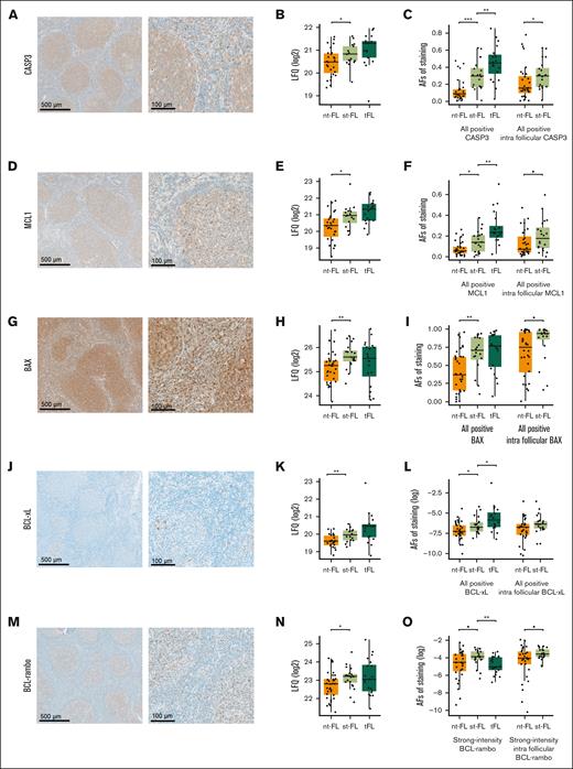 Staining patterns and expression levels of 5 selected apoptotic markers. (A) Representative images of immunohistochemical staining patterns of CASP3 expression (left, original magnification ×5; right, original magnification ×20). (B) CASP3 expression levels identified by MS-based proteomics. (C) CASP3 expression levels identified by immunohistochemical staining in whole biopsy and intrafollicular areas. (D) Representative images of immunohistochemical staining patterns of MCL1 expression (left, original magnification ×5; right, original magnification ×20). (E) MCL1 expression levels identified by MS-based proteomics. (F) MCL1 expression levels identified by immunohistochemical staining in whole biopsy and intrafollicular areas. (G) Representative images of immunohistochemical staining patterns of BAX expression (left, original magnification ×5; right, original magnification ×20). (H) BAX expression levels identified by MS-based proteomics. (I) BAX expression levels identified by immunohistochemical staining in whole biopsy and intrafollicular areas. (J) Representative images of immunohistochemical staining patterns of BCL-xL expression (left, original magnification ×5; right, original magnification ×20). (K) BCL-xL expression levels identified by MS-based proteomics. (L) BCL-xL expression levels identified by immunohistochemical staining in whole biopsy and intrafollicular areas. (M) Representative images of immunohistochemical staining patterns of BCL-rambo expression (left, original magnification ×5; right, original magnification ×20). (N) BCL-rambo expression levels identified by MS-based proteomics. (O) BCL-rambo expression levels identified by immunohistochemical staining in whole biopsy and intrafollicular areas. ▪P < .1; ∗P < .05; ∗∗P < .01; ∗∗∗P < .001. AF, area fraction.