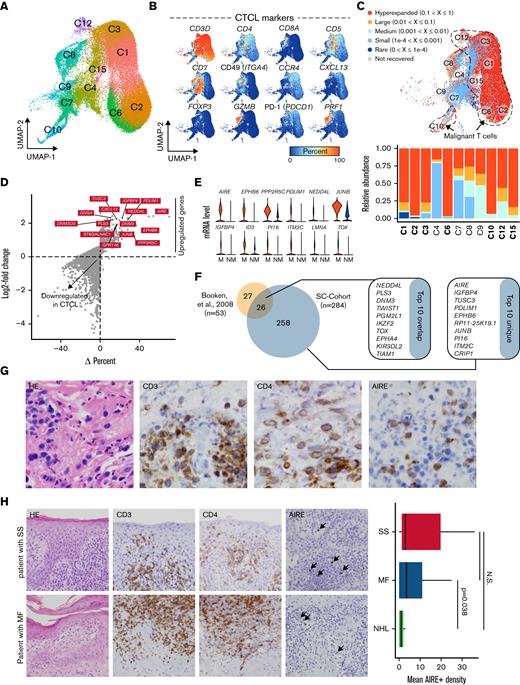 Differentiating malignant and nonmalignant T cells. (A) UMAP projection of CD3+ T-cell clusters. (B) Percent of cells expressing selected common markers for CTCL across the UMAP projection. (C) UMAP projection with proportion of total reads per sample of TCR V(D)J-based clonotype attached into the following grouping: hyperexpanded (0.1 < X ≤ 1), large (0.01 < X ≤ 0.1), medium (0.001 < X ≤ 0.01), small (1e−4 < X ≤ 0.001), and rare copies (0 < X ≤ 1e−4) using the scRepertoire R package22 with the percentage of cells in each clonotype category in the lower bar chart. Malignant T-cell clusters (C1, C2, C3, C6, C10, C12, and C15) had >50% of cells with hyperexpanded clonotypes. (D) Percent difference (Δ percent) between malignant and nonmalignant T cells vs log2-fold change with the top 10 significant (Bonferroni P value < .05) upregulated genes by both percentages and fold change labeled. (E) Violin plot of relative mRNA expression of the top 12 significant genes by Δ percent difference between malignant (M) and nonmalignant (NM) T cells. (F) Significantly upregulated genes in the single-cell (SC) cohort and a secondary SS cohort29 with the top 10 genes by a log-fold change in overlapping comparison and unique to the SC cohort. (G) Representative immunohistochemistry images for SS at 400× magnification. Representative images and data summary (bar graph) of 35 patients with MF, SS, or T-cell NHL. Black arrows indicate nuclear staining of AIRE, and the images displayed are at 200× magnification.