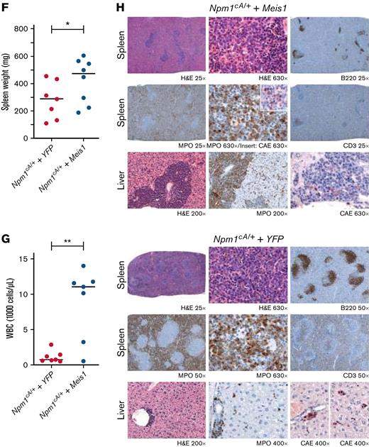 MEIS1 collaborates with NPM1c mutation to induce high-penetrance myeloid leukemia in mice. (A) MEIS1 expression in NPM1c de novo AML patients (n = 107) compared with NPM1WT AML patients (n = 340) from the Vizome data set.26 (B) MEIS1 expression in NPM1c de novo AML patients (n = 107) compared with CD34+ healthy BM (n = 13) from the Vizome data set.26 (C) GSEA analysis of 25% of highest MEIS1 (MEIS1High) expressing vs 25% lowest MEIS1 expressing (MEIS1Low) NPM1c de novo AML patients from the TCGA data set.27 (D) Schematic of the experimental design of in vivo experiments with Npm1cA/+ mouse model. (E) Kaplan-Meier plot of Npm1cA/+ mice transduced with a YFP empty vector (n = 8), Meis1 (n = 10), and secondary transplants of NPM1c+ Meis1 leukemic cells (n = 6). (F) Spleen weight of Npm1cA/+ mice (n = 7) transduced with an empty YFP control vector compared with Npm1cA/+ mice with Meis1 overexpression (n = 8). (G) WBC counts for Npm1cA/+ mice (n = 7) transduced with an empty YFP control vector compared with Npm1cA/+ mice with Meis1 overexpression (n = 7). (H) Histopathological analysis of a Npm1cA/+ plus YFP mouse compared with a Npm1cA/+ plus Meis1 mouse. ∗P < .05; ∗∗P < .001; ∗∗∗P < .0001. GSEA, gene set enrichment analysis; TCGA, the cancer genome atlas; WBC, white blood cell.