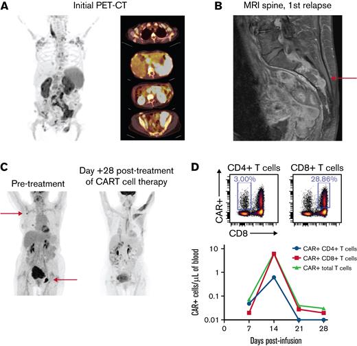 Initial and subsequent imaging of a patient with CNS MCL who achieved remission after brex-cel infusion. (A) Initial PET/CT scan demonstrating MCL within the bilateral cervical, supraclavicular, axillary, mediastinal, iliac, and inguinal regions; mild splenomegaly with diffuse hypermetabolism; bilaterally enlarged kidneys with hypermetabolic cortical thickening; nodular hypermetabolic foci along the large bowel; and diffuse bone marrow space hypermetabolism. (B) Magnetic resonance imaging of the spine at the time of first relapse. The red arrow indicates the presence of enhancing soft tissue posterior to the sacral spine nerve levels 2 and 3. (C) PET/CT scan prior to CAR T therapy and Day +28 after therapy. The red arrows highlight the presence of enlarged hypermetabolic left inguinofemoral and right axillary lymph nodes prior to treatment. These lesions resolved after CAR T therapy. (D) Upper plot shows CD8+ versus CD19 anti-idiotype–positive cells (CD19 anti-idiotype antibody is described in Jena et al24) on peripheral blood monocytes gated on live CD45+ CD3+ CD14− cells via a gating strategy as described previously.25 CD4+ and CD8+ CAR T-cells are shown on the left and right, respectively. On a log scale, the absolute number of circulating CD4+ (blue), CD8+ (red), and total CD19 CAR T-cells (green) after infusion as measured by flow cytometry over time.