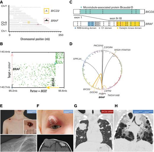 Molecular and clinical findings in patients with rare BRAF alterations. (A) Genome-wide coverage of fragments retrieved from a FFPE-TLC experiment targeting BRAF on a FFPE tissue sample from a patient from our cohort. A rearranged region to the BRAF gene (pink box) on chromosome 7 (Chr7) was identified by the concentration of fragments clustered around the BICD2 gene (yellow box) on chromosome 9. (B) Butterfly plot uncovering the reciprocal BICD2::BRAF rearrangement. Proximity-ligation products between the target gene (BRAF) and rearrangement partner (BICD2) are depicted (in green). Strand directions are indicated by arrows. See supplemental Figure 10 for details about FFPE-TLC technology. (C) Illustration of the identified BICD2::BRAF fusion. (D) Circos plot depicting the 3 distinct BRAF rearrangements identified in patients from our cohort (in orange), as well as other BRAF rearrangements previously identified in patients with LCH (in gray).17,25,57-59 (E) Clinical and conventional radiography images of a patient from our cohort with BRAFV600D-mutated SS-UFB LCH, who had a single osteolytic lesion in the right clavicle with remarkable abscess-like soft tissue extension through the skin. (F) Clinical and magnetic resonance imaging images of a patient from our cohort with BRAFV600D-mutated SS-MFB LCH, who had a relapse of MFB disease with a remarkable orbital lesion with clear skin changes. (G) Coronal image of a chest computed tomography scan showing atypical pulmonary lesions in the patient with a BICD2::BRAF fusion. Shown are multiple solid nodules in both lungs, including a very large tumor in the right upper lobe measuring 55 × 18 × 15 mm. A biopsy of this tumor excluded cooccurrence of lymphoma or another disease and revealed clusters of CD1a+ CD207+ cells, compatible with LCH. (H) Coronal image of a chest computed tomography scan showing many large cystic lung lesions in a child with high-risk LCH harboring both BRAFV600E and BRAFR603Q mutations. Professional illustration of panel C made by ProteinPaint software.60 mb, megabase.