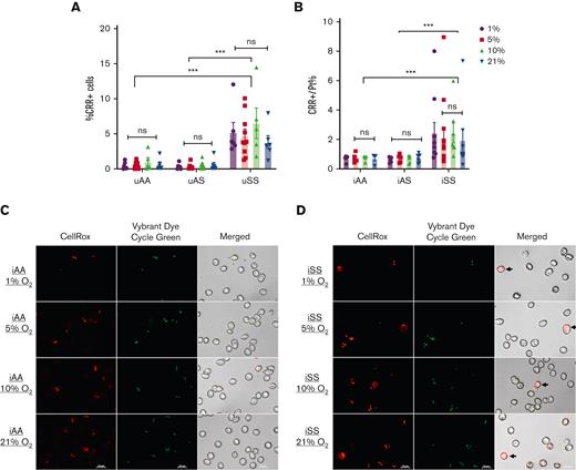 High oxidative stress in SS cells persists across culture conditions with different O2 concentrations. (A) uAA, uAS, and uSS cells were examined for CRR. The percentage of CRR+ cells (y-axis) was low in uAA and uAS cells and similar across all O2 levels (P = .5021). As expected, uSS cells had a higher percentage positivity for CRR, almost fourfold higher than uAA (P < .0001). However, between O2 conditions, the percentage of CRR+ cells in uSS did not change significantly (P = .6227). (B) A similar trend was seen in CRR+ cells normalized to parasitemia in iAA, iAS, and iSS cells. Although iAA and iAS cells had low positivity for CRR, iSS cells had 2.5-fold more CRR+ cells, as compared with iAA and iAS (P < .0001). This also indicates that most of the CRR positivity in iAA and iAS originates from parasite-harboring cells, because when normalized to parasitemia, they showed very few cells as CRR+. (C) Confocal images of iAA at 1%, 5%, 10%, and 21% O2 levels and stained with CRR (red) and Vybrant DyeCycle (FITC). The images indicate complete colocalization between parasite (seen clearly in their classical 1N, 2N, or 4N forms) and CRR signal. Thus, ROS in iAA cells is mostly restricted to infected cells, and surrounding bystander cells have nondetectable levels of oxidative species. (D) Confocal images of iSS at 1%, 5%, 10%, and 21% O2 levels and stained with CRR (red) and Vybrant DyeCycle (FITC). The images across different O2 levels indicate presence of CRR signal in uninfected cells (shown in black arrows) and in addition, colocalization between parasite and CRR signal. Scale bar = 10 μm.