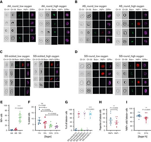 Shape of RBCs affects parasite proliferation in SS cells. (A) AA RBCs infected with B divergens were imaged at day 3 of infection. More than 99% of the cells were classified as “round” by the ML algorithm as shown in the representative images. Cells were stained with anti-GPA (violet), Vybrant Green (nucleus of Babesia), and anti–HbF-APC. All cells expressed GPA, and Babesia was seen as green dots in the cells with 1N, 2N, and 4N nuclei. (B) AS cells were similarly stained and analyzed by image cytometry. More than 98% of the cells were classified as “round” by the ML algorithm, and Babesia was seen as green dots in the cells with 1N, 2N, and 4N nuclei. (C-D) SS cells were stained similarly and imaged at low O2 (C) and high O2 (D) conditions. A fraction of cells appeared as sickled at both concentrations, although the “sickle” population was significantly higher at low O2 conditions, as shown in the images. Most SS cells that were classified as “sickle” did not harbor the parasite, and for the few which did, the DNA content was usually always found to be 1N. The “round” cells classified in SS RBCs were shown to be the predominant cell harboring the parasite. (E) The percentage of cells expressing HbF was plotted (mean ± standard error of the mean) for AA (1.843 ± 0.4087), AS (4.755 ± 1.123), and SS (51.17 ± 1.123). The difference in HbF+ cells was statistically significant among the genotypes. (F) The percentage of cells that were classified as “sickle” by the ML algorithm was plotted at different O2 levels for Babesia-infected SS cells (n = 5). The percentage of sickling cells reduced as the cells were incubated at higher O2 levels, and this change was statistically significant (P = .0357). (G) Babesia-infected cells were gated and then checked for “sickle” or “round” shape in infected SS samples. As evident from the graph, almost all Babesia-infected host SS cells were “round” and not “sickle” with a P value of <.0001. Differences in these were not significant between different O2 concentrations; therefore, across all different O2 concentrations tested, Babesia invaded “round” cells more often than “sickle” cells. (H) The proportion of Babesia+ cells in normalized HbF+ or normalized HbF–- cells grown under 1% O2 was calculated. Thus, if HbF+ and HbF– cells are present in similar numbers, parasites prefer HbF+ cells over HbF– cells (P = .0055, n = 8). (I) Comparison of the percentage of all parasitized cells that are HbF+ at 1% and 21% O2. As compared with parasites at 1% O2, parasites at 21% O2 seem to have a diminished preference for HbF+ cells (P = .0047, n = 10). Scale bar: Enlarged Brightfield (BF) image shown beside Fig. 4C.; scale = 7 μm.