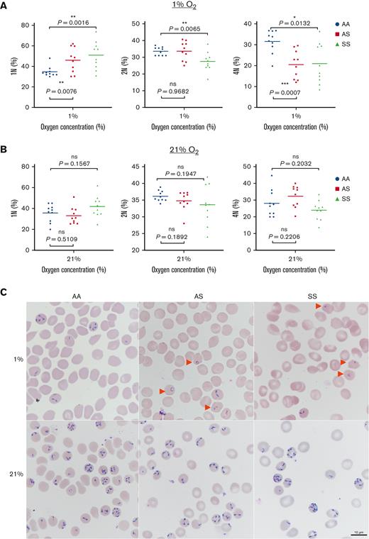 Examination of changes in parasite population structure when grown in different RBC genotypes and under different O2 conditions. Parasite subpopulations exist as 1N, 2N, or 4N and >4N and in wild-type cells are maintained at ∼ 33%:33%:33%. (A) Represents subpopulations at 1% O2; (B) represents 2N subpopulations at 21% O2. Within the AA genotype, the population structure of growing parasites is almost equally divided between 1N, 2N, and together 4N and >4N. As evident from the graphs, within the AA RBCs, the population structure was similar across both O2 conditions. (A) When grown in AS cells, parasites had a higher percentage of 1N at 1% O2 (46.09% ± 3.84%) and significant reduction in 4N populations as compared with AA (20.479% ± 2.12% in AS vs 31.529% ± 1.73% in AA). For SS RBCs, at 1% O2 (hypoxia), 1N contributes 51.006% ± 4.298% to the population structure, thus explaining the stunted growth at these hypoxic conditions. (B) At 21% O2, 1N, 2N, and 4N of AS changed to 33.09% ± 2.58%, 34.78% ± 0.89%, and 32.27% ± 2.066%, respectively, which is largely similar to the wild-type AA 33%:33%:33% pattern. In SS host cells, parasite subpopulations exhibit a major recovery compared with 1% O2 with 1N, 2N, and 4N at 41.82% ± 3.26%, 33.625% ± 1.829%, and 23.977% ± 1.829%, respectively. None of these at 21% O2 are statistically significant when compared with parasite structures in AA cells. (C) Giemsa-stained images of parasites grown in AA, AS, and SS RBCs at 1% and 21% O2. As evident in representative images, at lower O2 levels, rings (marked with red arrows) were more prevalent in AS and SS cells. As O2 concentrations are increased, parasites grown in AS RBCs appear identical to the parasites in AA RBCs. Parasites grown in SS RBCs also recover and appear similar to the wild type at hyperoxic conditions. Scale = 10 μm.