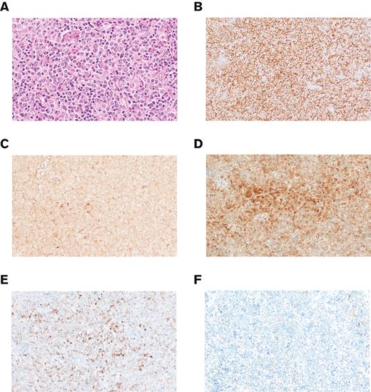 Morphology and immunophenotype of tFL-PMBLsig-pos cases. (A) The tFL-PMBLsig-pos (case 2) is composed of sheets of large B cells with predominantly centroblastic cytology that coexpress CD20 and CD10 (not shown). (B) CD23 is diffusely positive. (C) CD30 shows prominent background nonspecific staining with only rare strongly positive cells. (D) A large subset of the neoplastic B cells expresses MAL and (E) CD200 but is negative for (F) CD273/PDL2. Original magnifications ×500 (A) and ×200 (B-F); A, hematoxylin and eosin stain and B-F, immunohistochemical stain with hematoxylin counterstain.