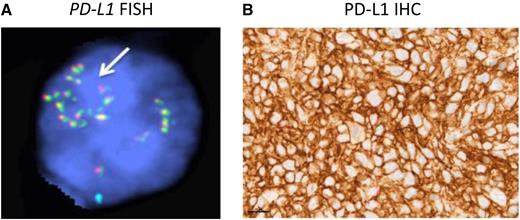 PD-L1 FISH and PD-L1 IHC in a patient with response to pembrolizumab. (A) Representative PD-L1 FISH demonstrating a PD-L1 gene amplification in a patient with DLBCL. PD-L1 and centromere 9 FISH probes are shown in orange and blue, respectively. (B) Representative PD-L1 IHC demonstrating intense PD-L1 protein expression on tumor cells from the corresponding case in panel A.