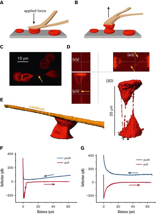 Mechanical challenge of human RBCs by atomic force spectroscopy. (A) Schematic drawing of the mechanical challenge owing to application of the cantilever of an AFM with forces of up to 400 pN applied. RBCs were attached to the cantilever with Cell-Tak (BD Biosciences, San Jose, CA) and spontaneously adhered to the microscope dish (microdish). (B) Schematic drawing showing the retraction of the cantilever with measurement of the separation force. (C) Confocal image of RBCs labeled with the membrane dye CellMask (Life Technologies, Carlsbad, CA) at 1:2000 for 10 minutes. The yellow arrow points to a tether, clearly connecting 2 RBCs. Scale bar, 10 μM. (D) Two RBCs were pushed together and separated, as outlined in panels A and B, in a plasma-like solution containing 40 mg/mL dextran (70 kDa). Shown are optical sections and the 3D reconstruction with clearly visible tethers in the x/z and y/z planes (yellow arrows) but few visible tethers in the x/y plane. The 3D reconstruction, in addition to the optical sections, reveals uneven staining of the tethers, suggesting the presence of lipid rafts or other molecular agglomerations. It is of little importance whether the tethers form between RBCs or between an RBC and the substrate, as protein transfer could potentially also occur between RBCs and structures of the spleen. (E) Even without the formation of tethers, RBCs strongly interact, potentially allowing a protein transfer. (F) Atomic force spectroscopy measurement reflecting the situation imaged in panel E with an RBC interaction time of several seconds. (G) Representative atomic force spectroscopy measurement with a contact time close to 0 and a velocity of the cantilever movement of 5 μm/s in a dextran solution (40 mg/mL dextran 70 kDa) used to mimic plasma. Such a probing is too fast to be imaged by confocal microscopy.